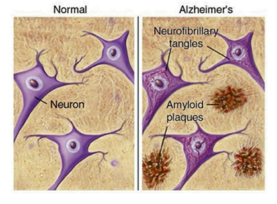 screenshot 2021 01 28 14 13 50 760 com7878136885448595903 Alzheimer’s disease & Cognition enhancers
