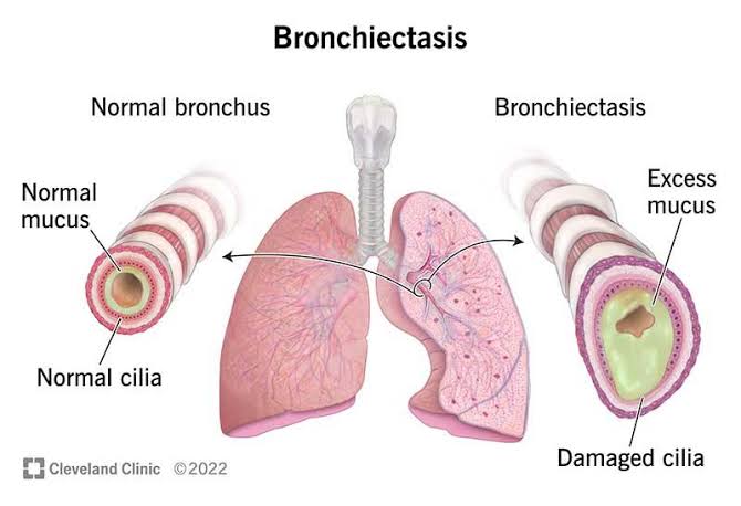 Lungs What is bronchiectasis? || Bronchiectasis || Causes, symptoms, types of headache, treatment || bronchitis